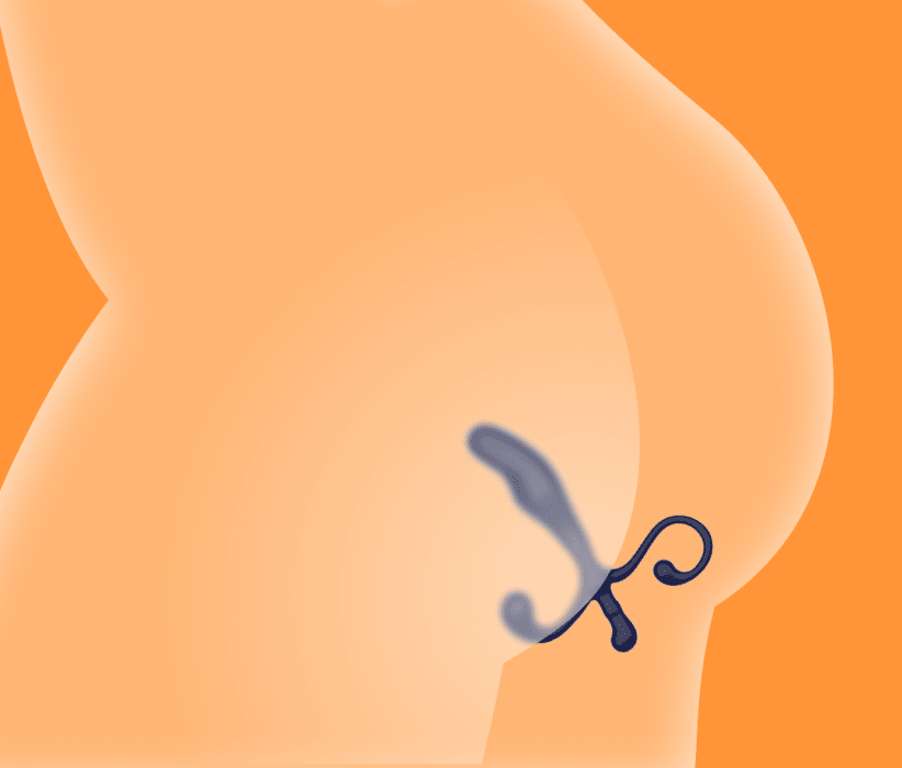Prostate Plug